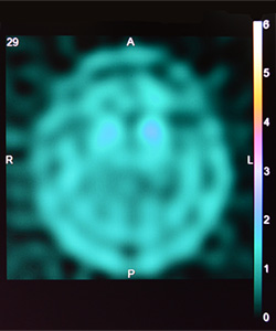 認知症　DAT-SCAN