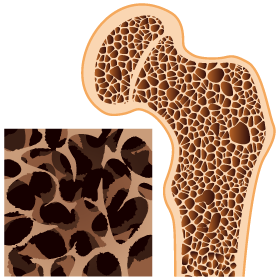 骨粗しょう症の骨