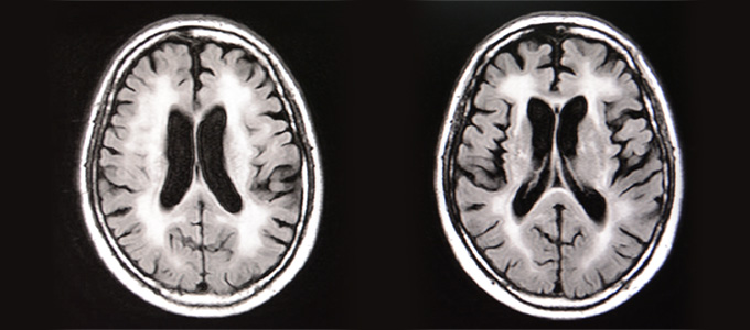 認知症　MRI